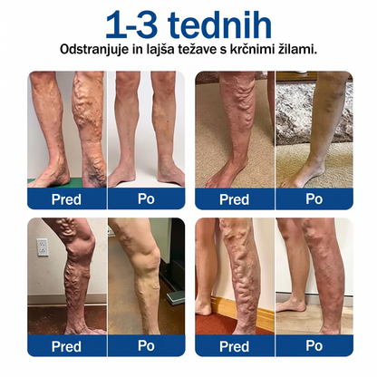 ✨🌿 Medistart® mikroneedling obliž za nego krčnih žil ⚡ Takojšnje olajšanje, dolgotrajni rezultati